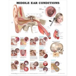 Middle Ear Conditions...
