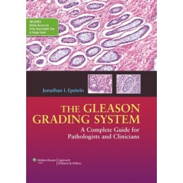 The Gleason Grading System: A Complete Guide for Pathologist and Clinicians