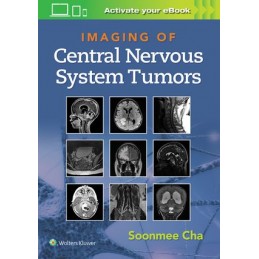 Imaging of Central Nervous System Tumors