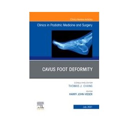 Cavus Foot Deformity, An...