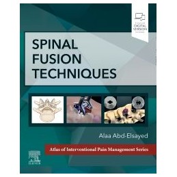 Spinal Fusion Techniques